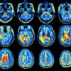 Psychologists connect traumatic brain injury to mental health problems